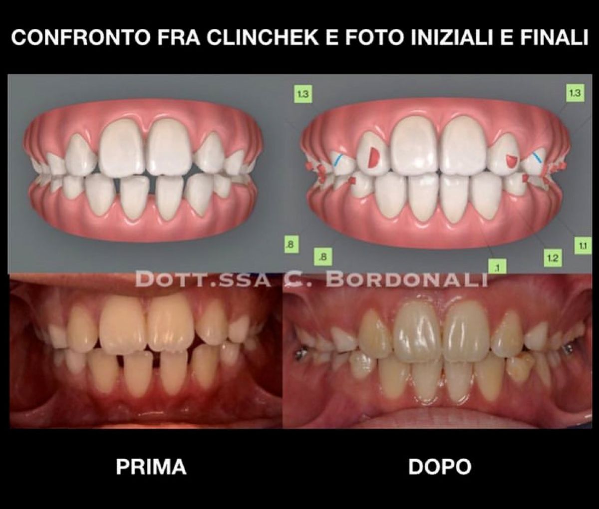 Elastici intraorali e loro uso